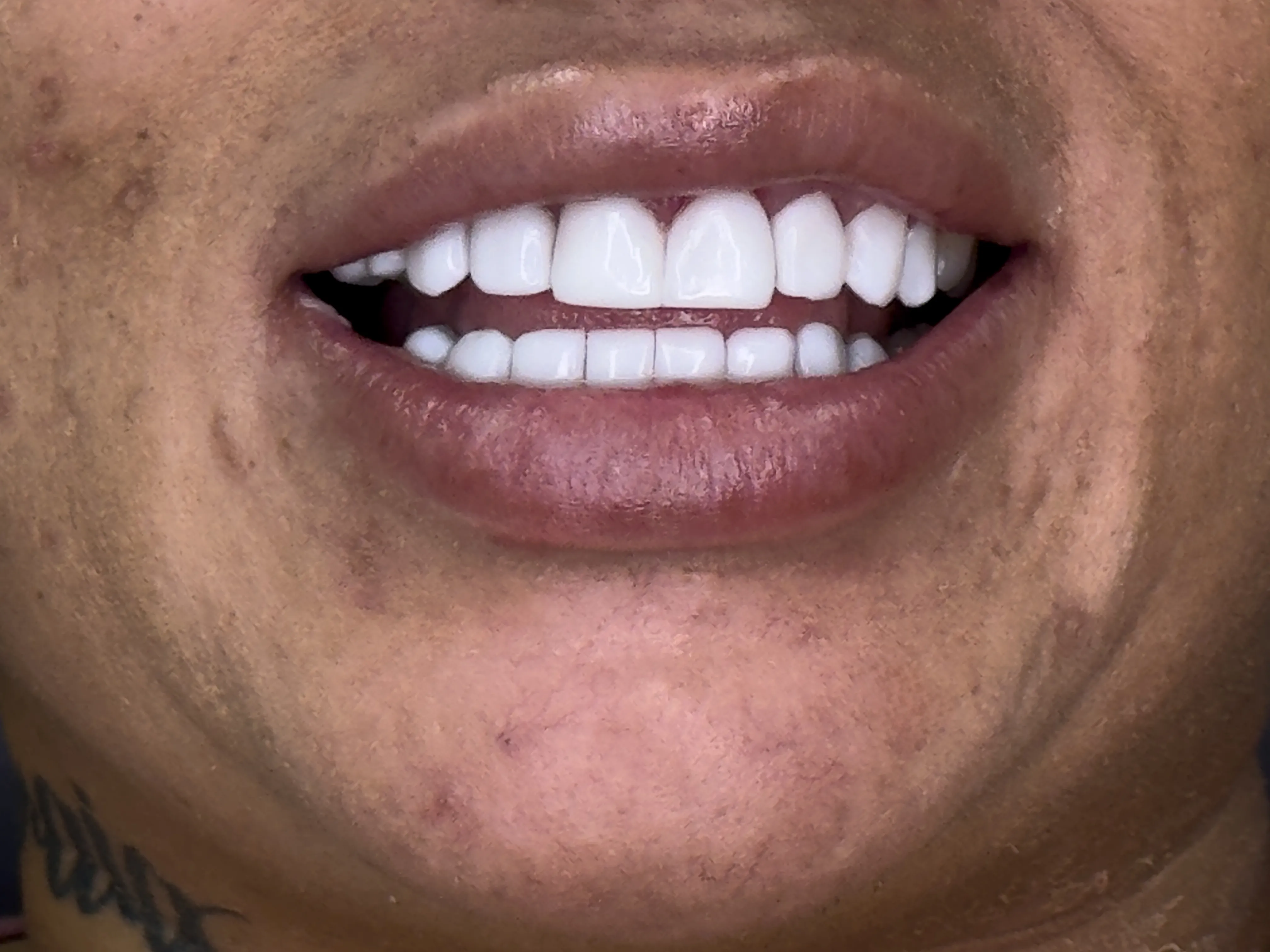 Smile restored with Smile Forever resin veneers