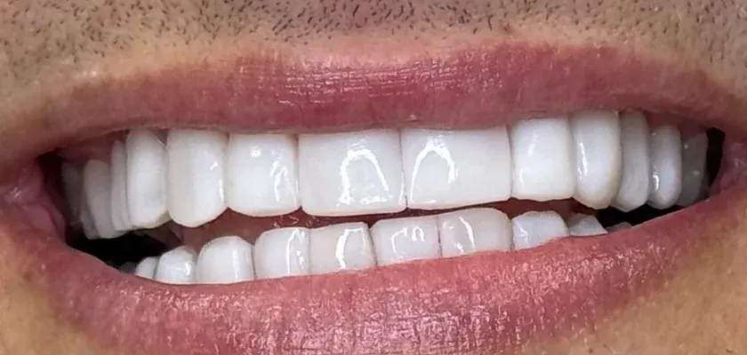 After: gaps and uneven edges corrected with polyresin veneers