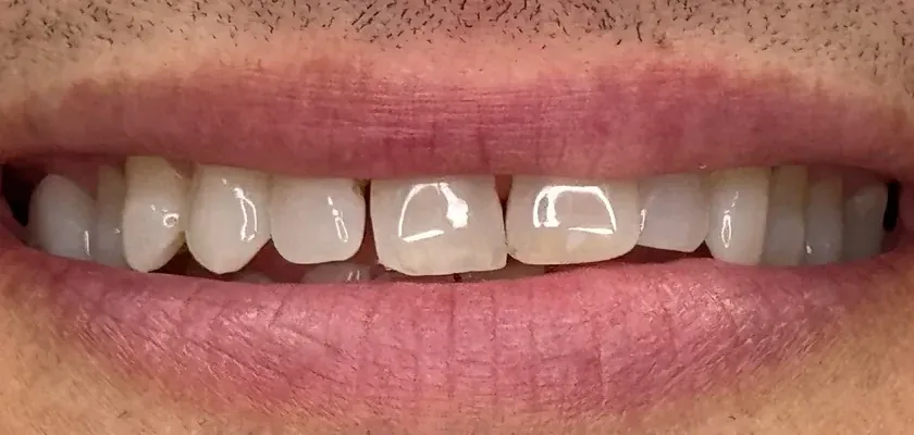 The same smile before treatment