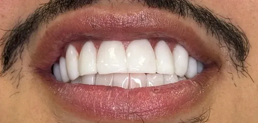 After: crowded front teeth reshaped with resin veneers