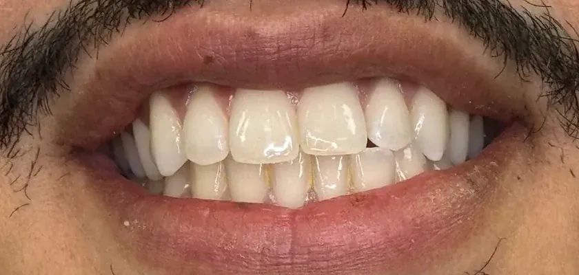 The same smile before treatment