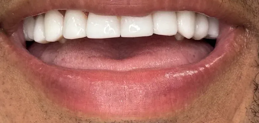 After: stained teeth brightened with resin veneers