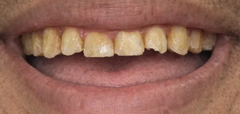 The same smile before treatment