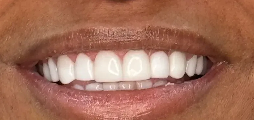 After: gap between the front teeth closed with polyresin veneers