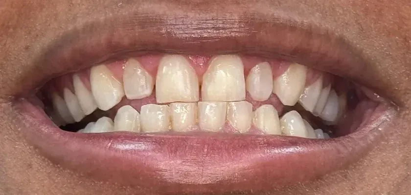 The same smile before treatment