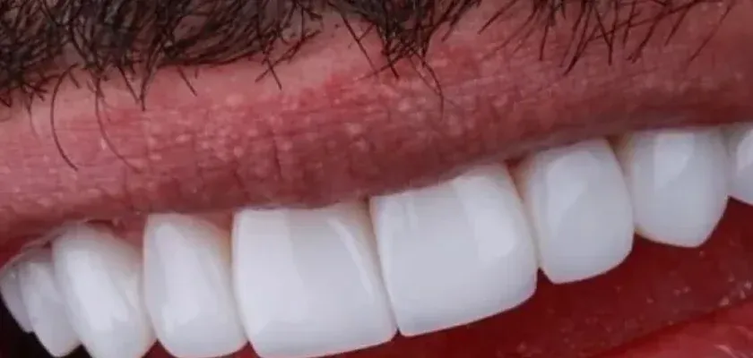 After: worn, uneven front teeth restored with porcelain veneers
