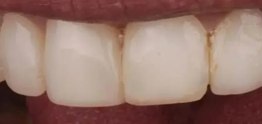 The same smile before treatment
