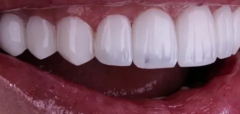 After: short, uneven teeth lengthened with porcelain veneers