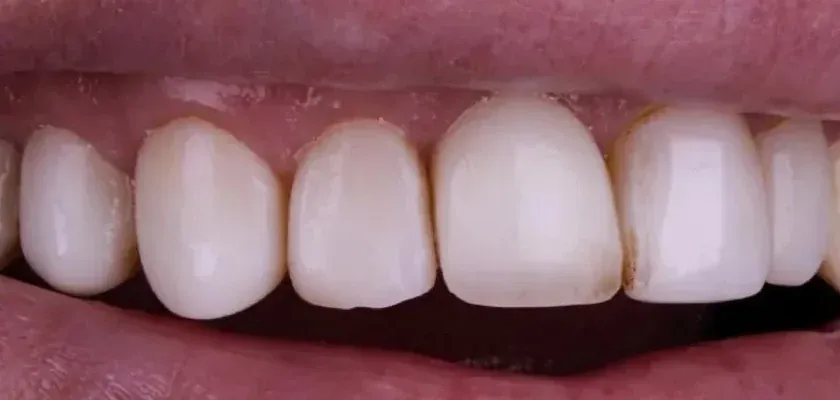 The same smile before treatment