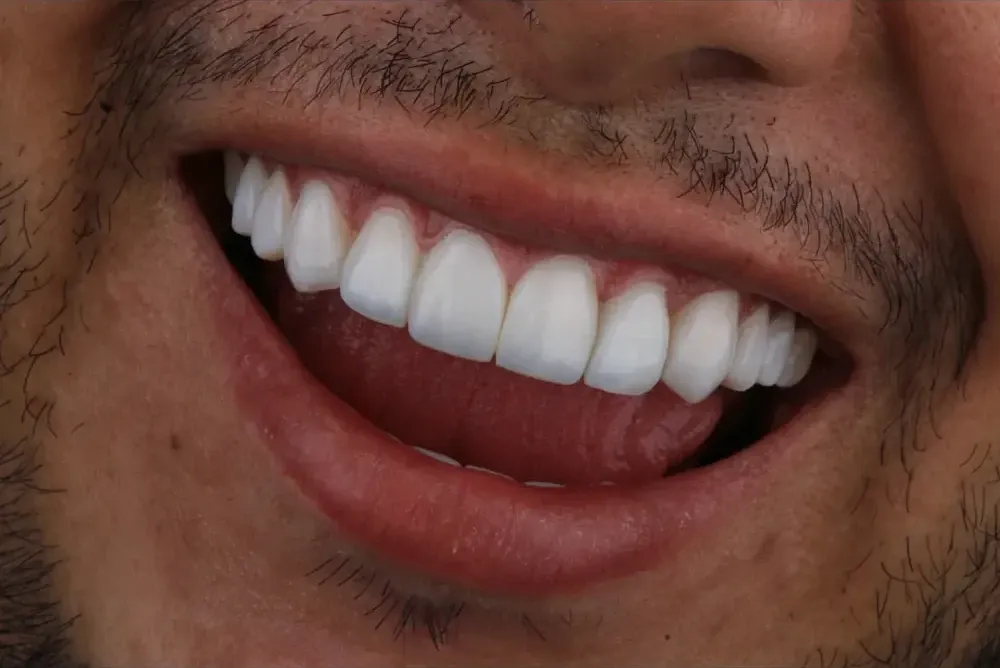 Close-up of a patient's smile after porcelain veneers at Smile Forever Design