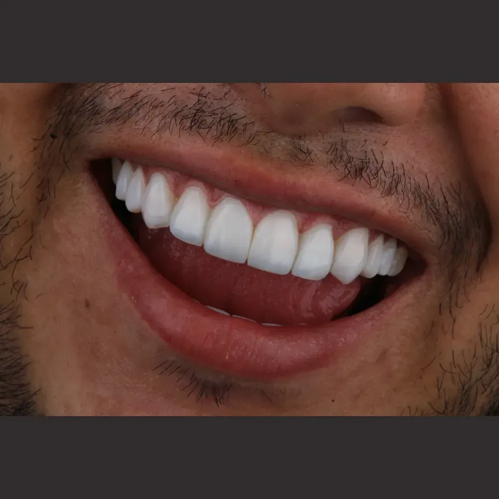 Close-up of a smile restored with Smile Forever porcelain veneers